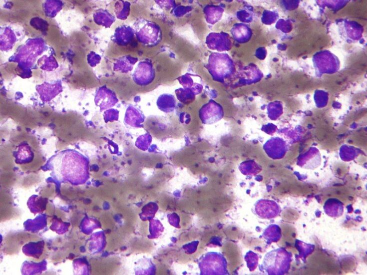 Kite Reports Positive Results Of Yescarta In B-cell Lymphoma