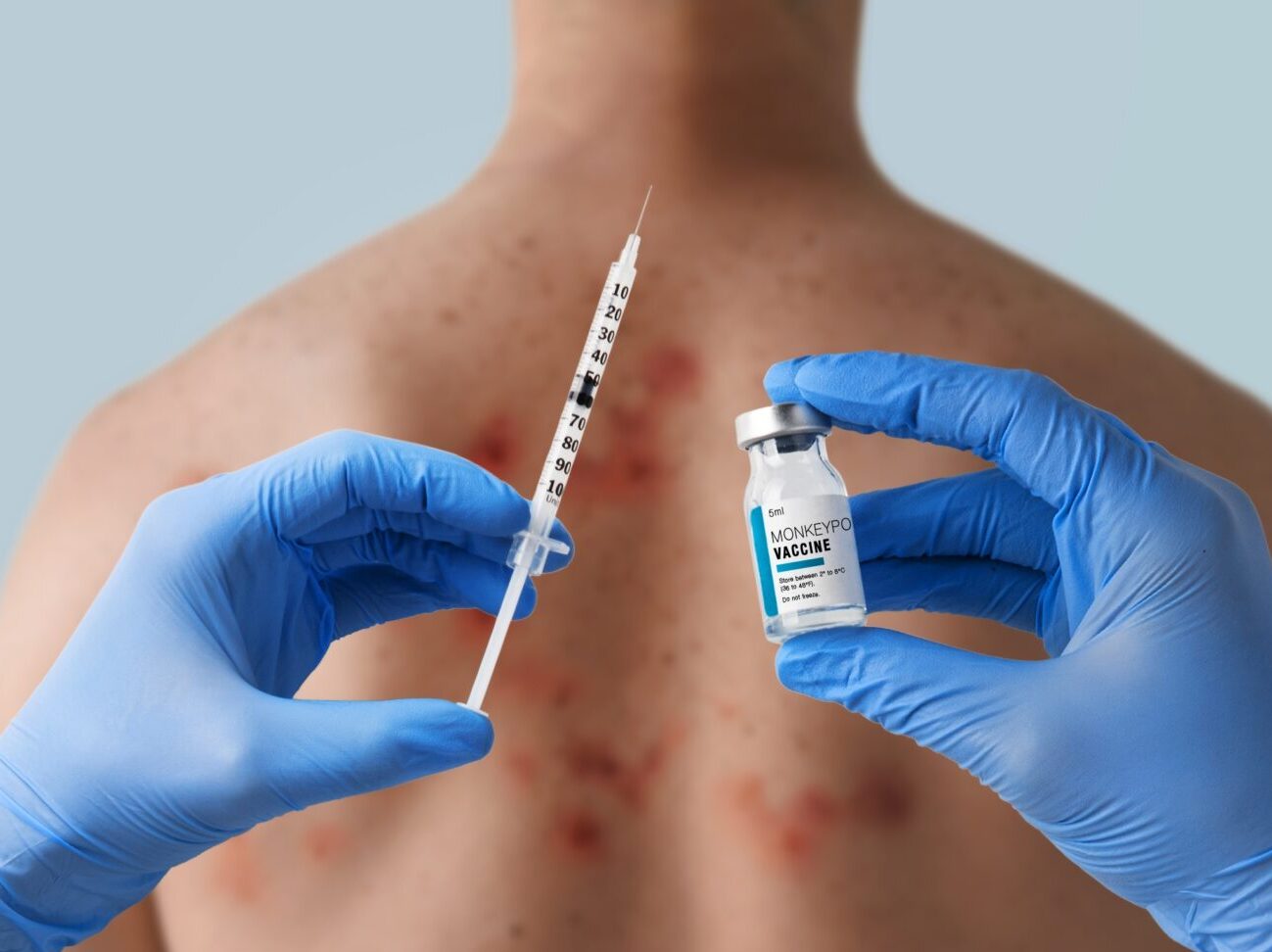 Multiple Monkeypox Vaccine And Antiviral Trials Are Launching Across ...